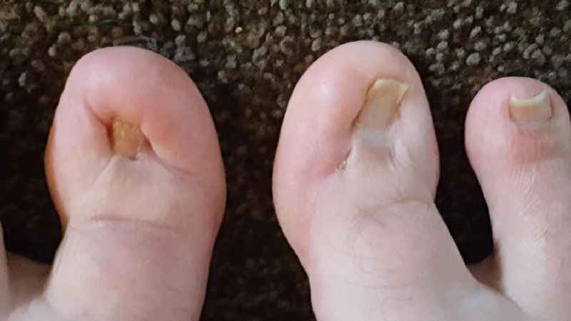 How long will my toe hurt after toenail removal