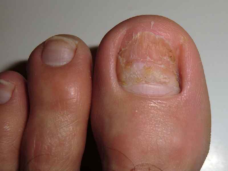 How long will my toe ooze after nail removal