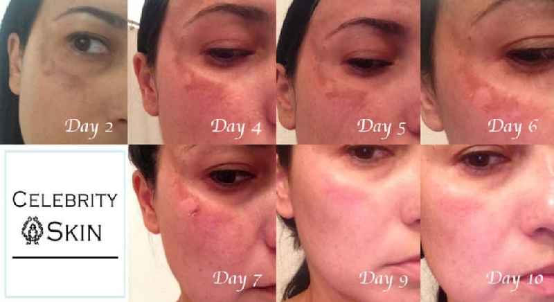 How many days does your face peel after chemical peel