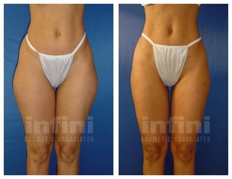 How many inches does liposuction remove