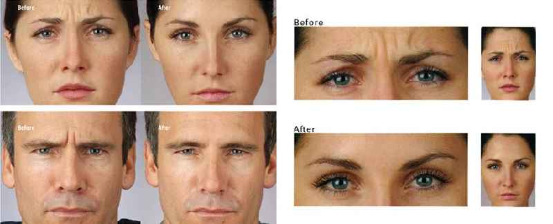 How many laser treatments do you need for upper lip