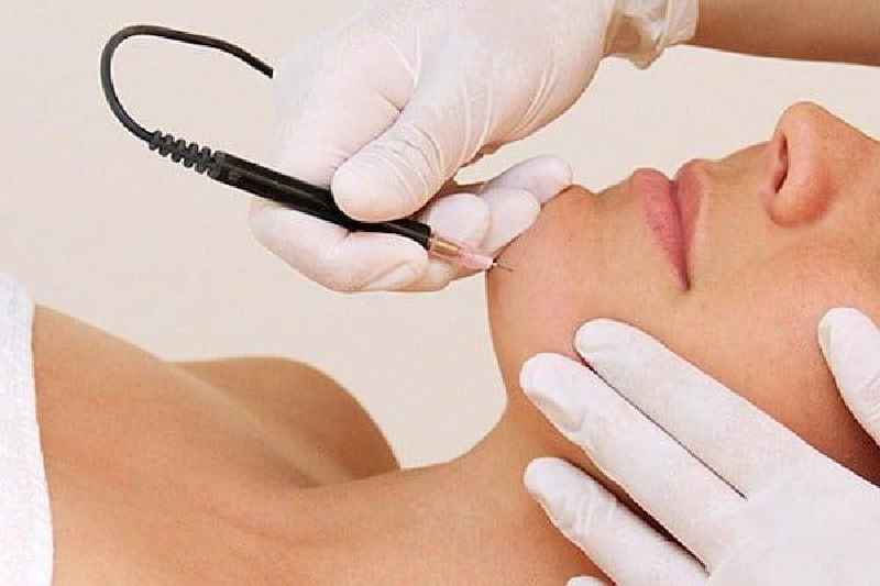 How many laser treatments does it take to permanently remove hair
