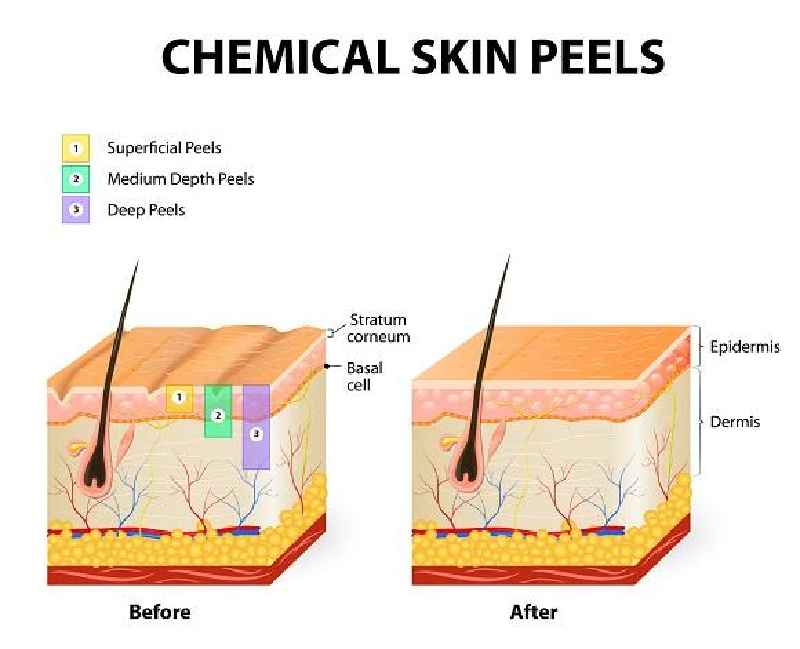 How many layers of skin does chemical peel remove