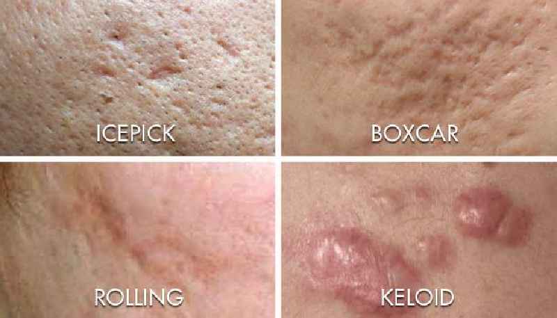 How many microneedling sessions does it take to get rid of acne scars