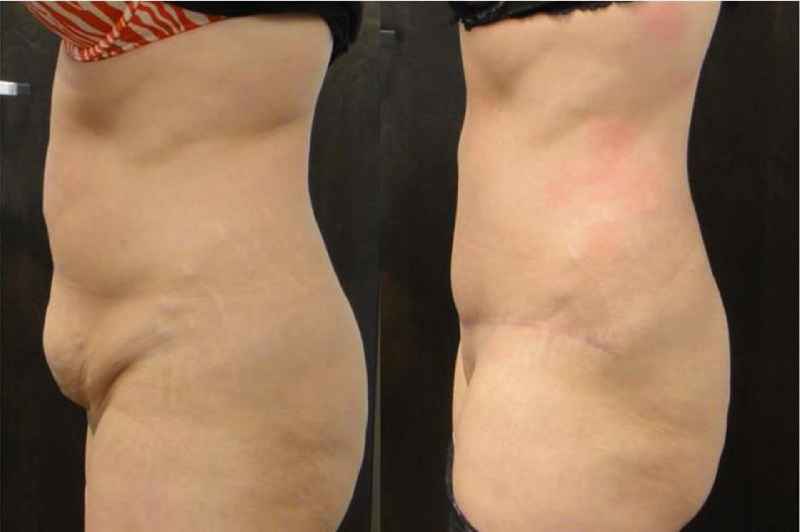 How many pounds can liposuction remove