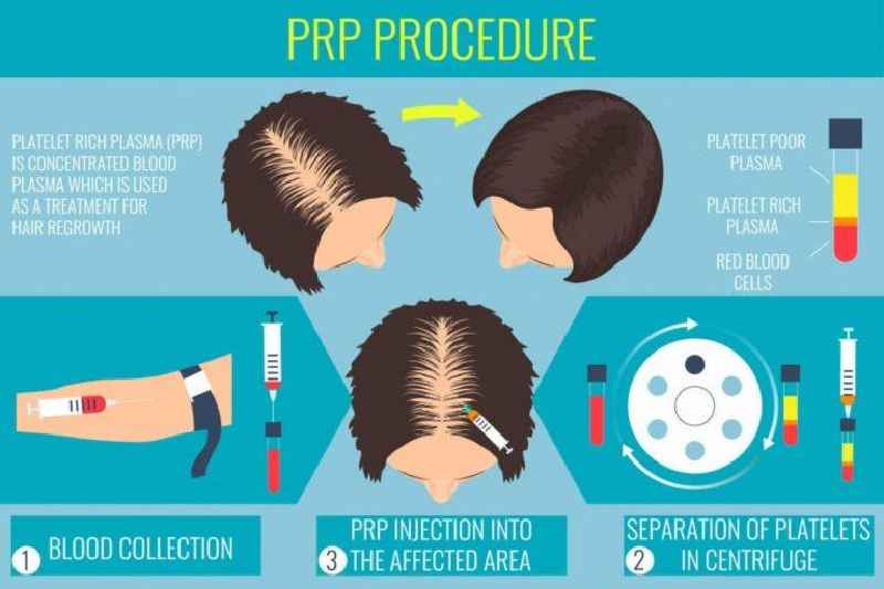 How many PRP sessions should I take for hair loss