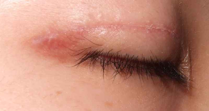 How many types of eyelid surgeries are there