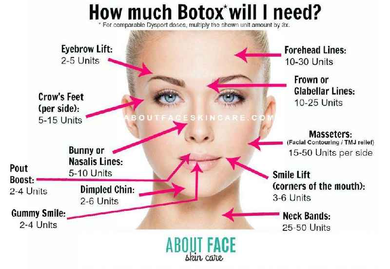 How many units of Botox do I need for forehead