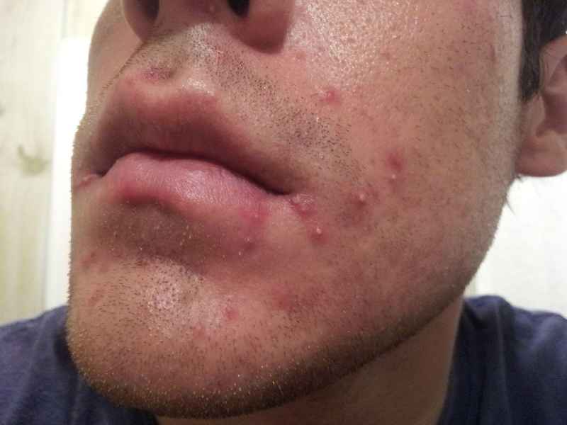 How much acne is normal