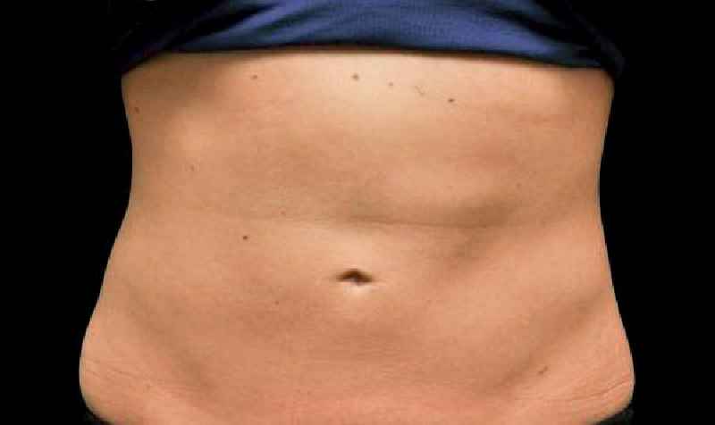How much belly fat can CoolSculpting remove