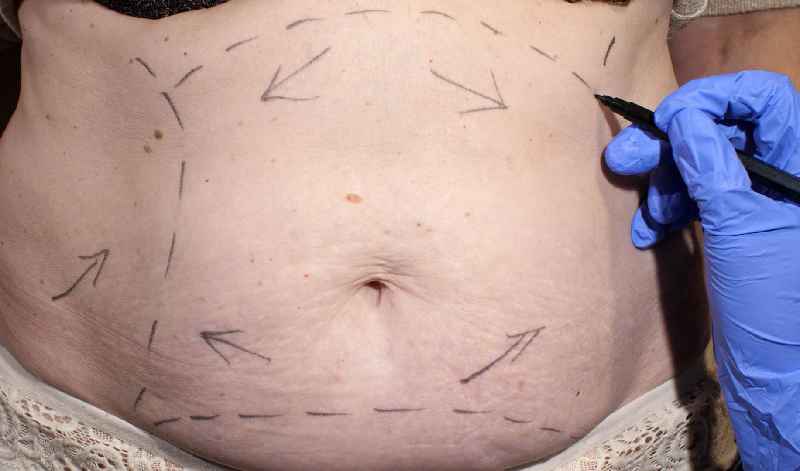 How much do you need to weigh to get liposuction