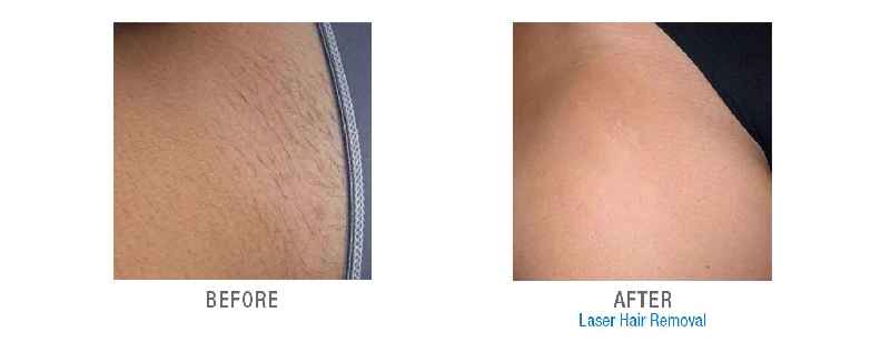 How much does a Brazilian laser hair removal cost