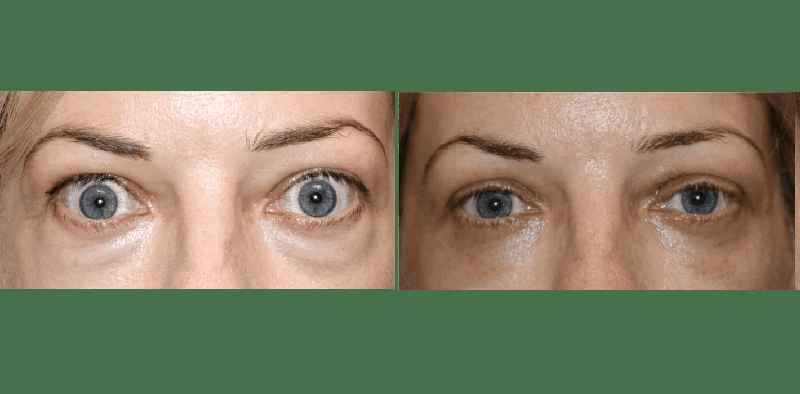 How much does blepharoplasty cost
