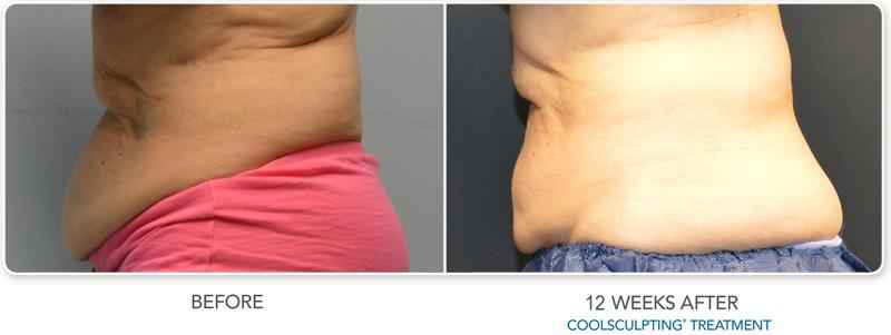 How much does CoolSculpting cost on your stomach