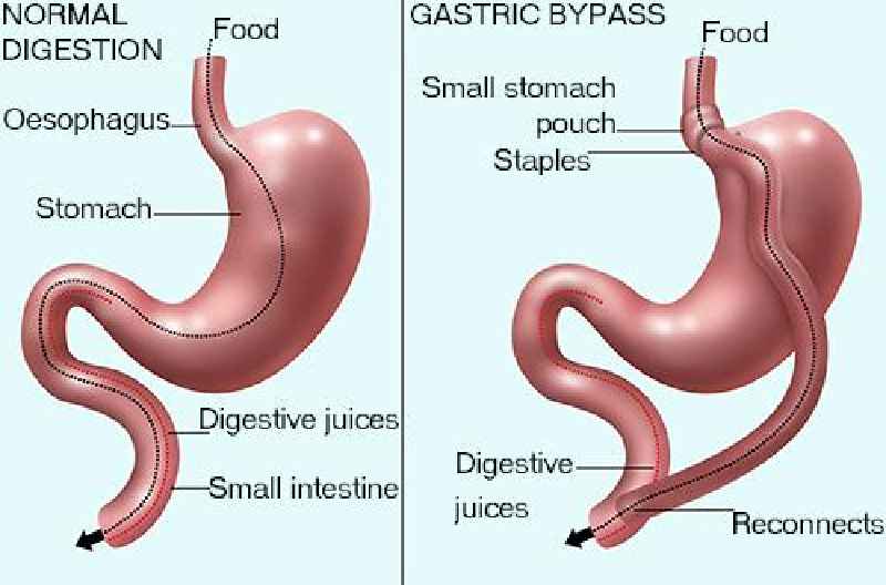 How much does gastric sleeve cost