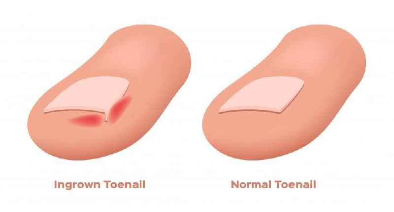 How much does it cost to have a ingrown toenail removed