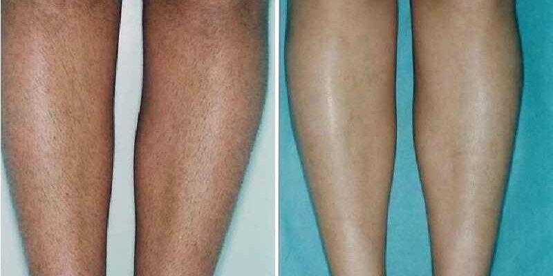 How much does it cost to permanently remove body hair