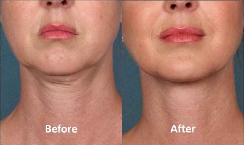 How much does it cost to tighten skin under chin