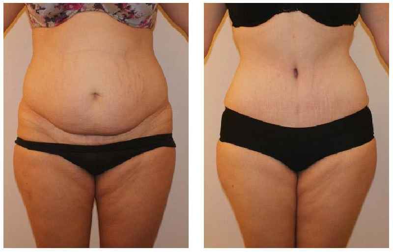 How much fat can liposuction remove