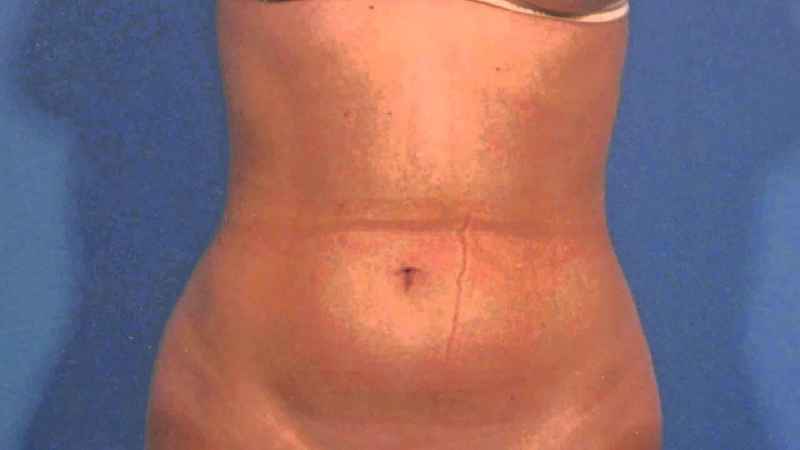 How much fat can tummy tuck remove