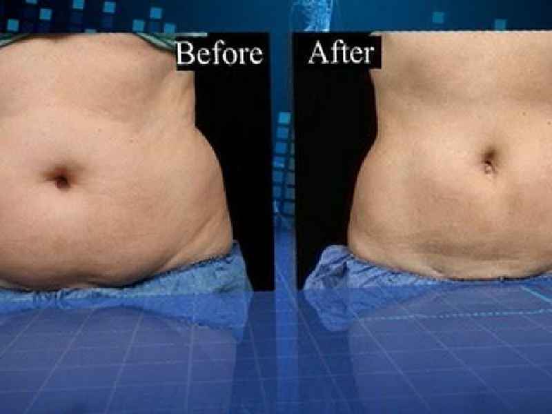 How much fat does CoolSculpting remove