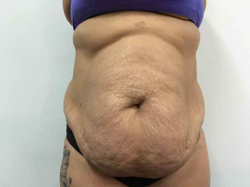 How much is a tummy tuck in Mexico