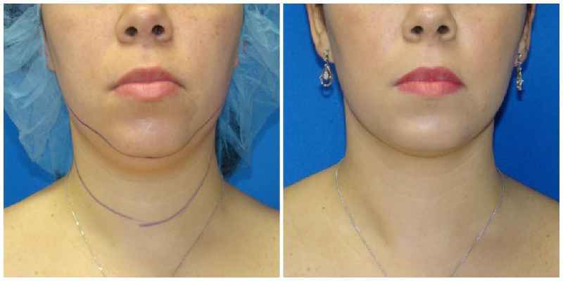 How much is chin lipo in Mexico