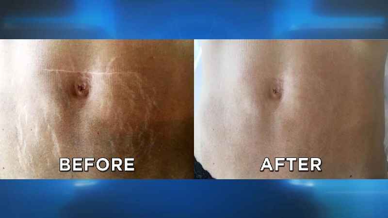 How much is cosmetic surgery for stretch marks