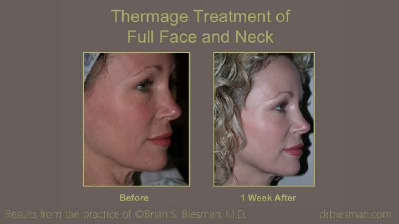 How painful is a neck lift