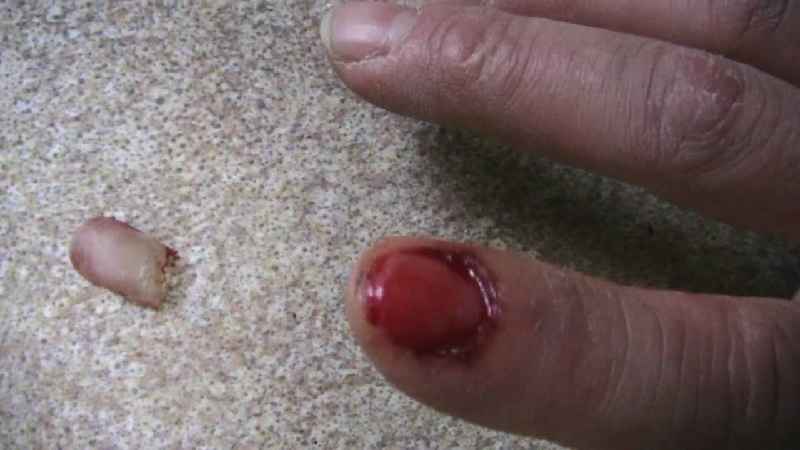 How painful is ripping off a nail