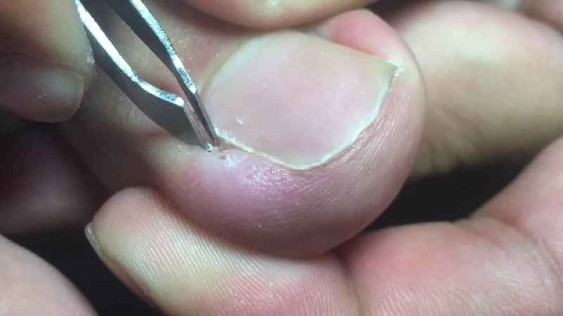How painful is toenail removal after