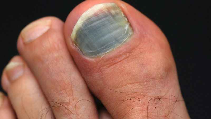 How painful is toenail removal