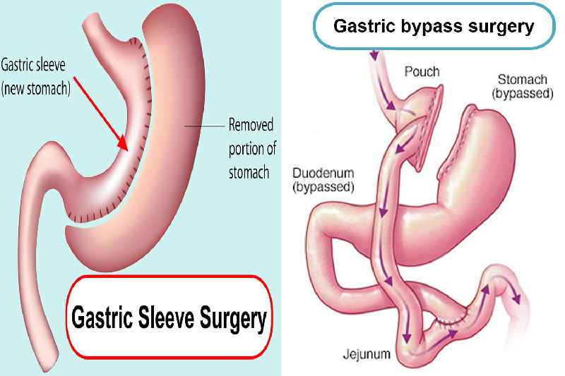 How quickly do you lose weight after gastric sleeve surgery