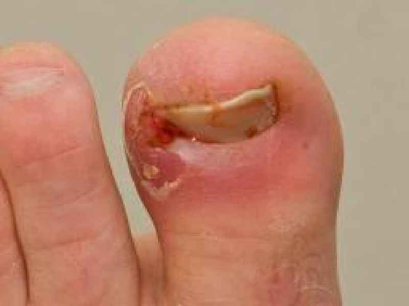 How soon can I drive after toenail removal