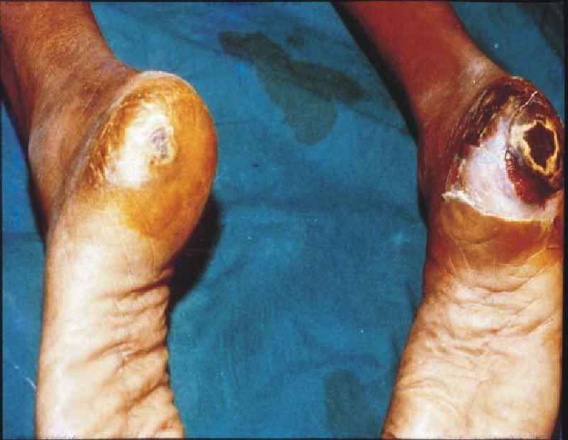 How the foot ulceration may be a complication of diabetes