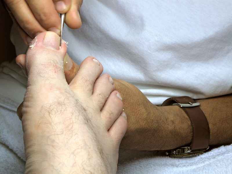 How would a podiatrist treat an ingrown toenail