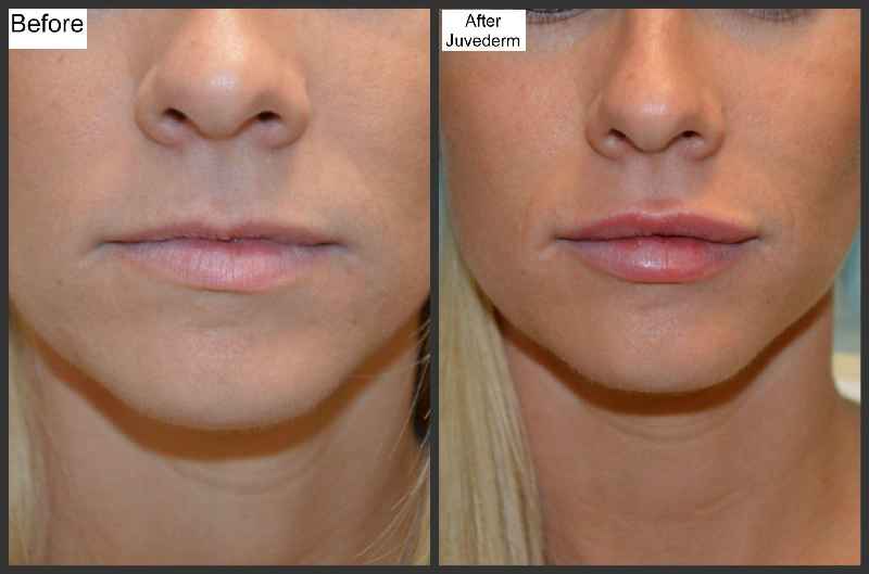 Is 1 syringe of Juvederm enough for lips