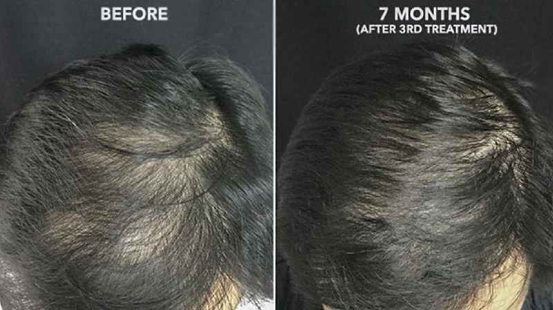 Is 6 laser hair treatments enough