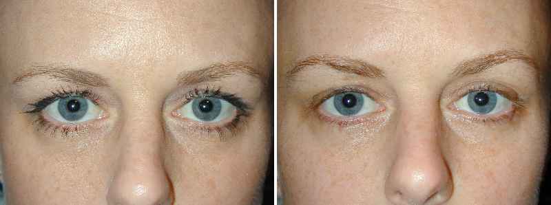 Is a brow lift better than Botox