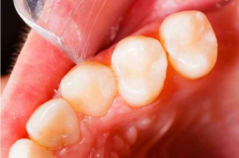 Is a cavity filling considered cosmetic