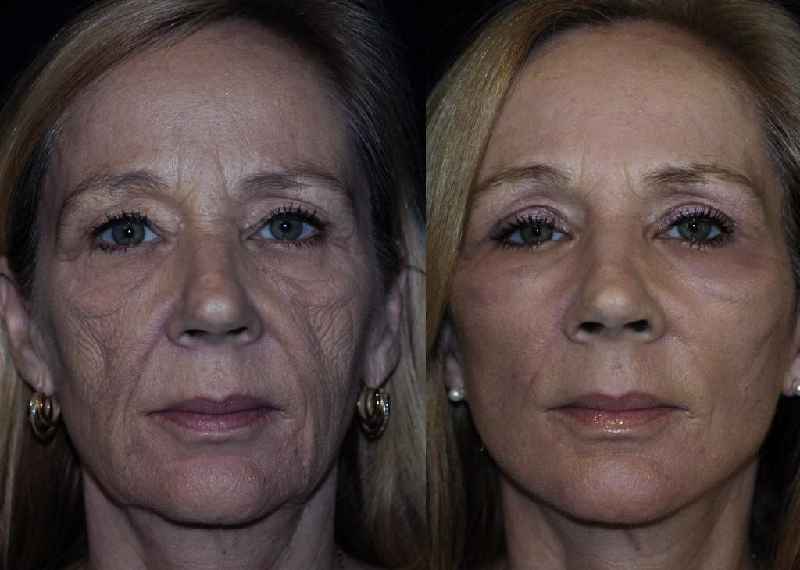 Is a mini facelift the same as a neck lift
