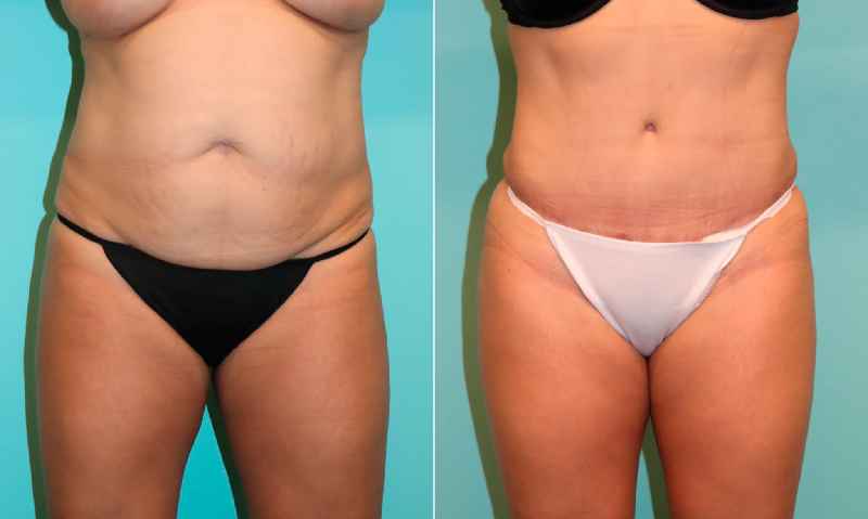 Is a tummy tuck covered by BC medical