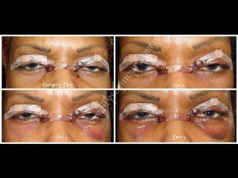 Is an upper and lower blepharoplasty painful