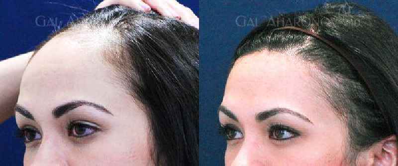 Is autoimmune hair loss permanent