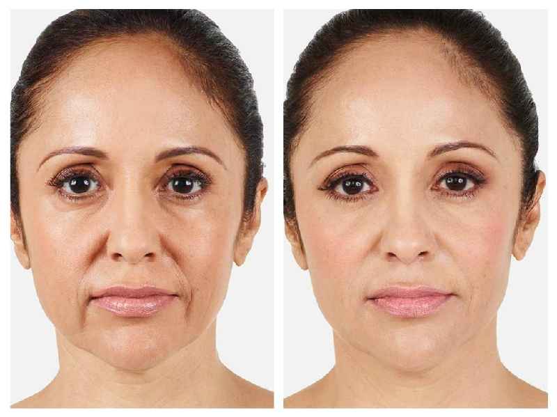 Is Botox or filler better for under eye wrinkles