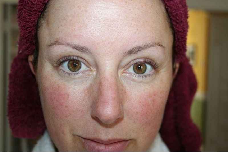 Is cetearyl alcohol bad for rosacea