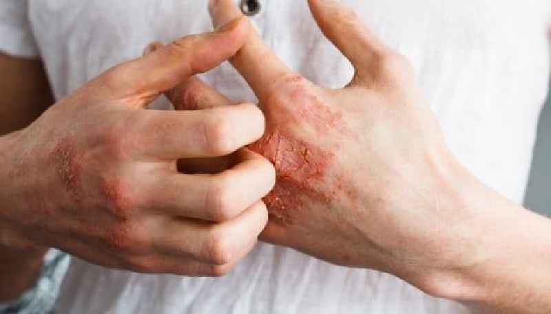 Is cetearyl alcohol good for eczema