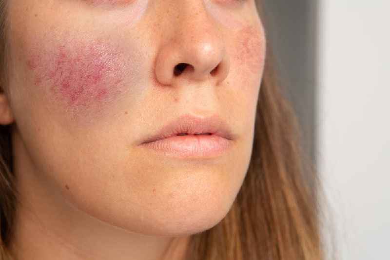 Is cetearyl alcohol good for rosacea