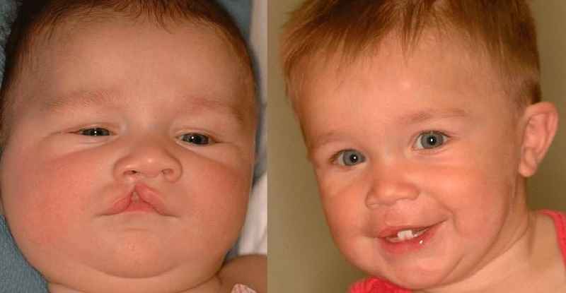 Is cleft lip surgery considered cosmetic