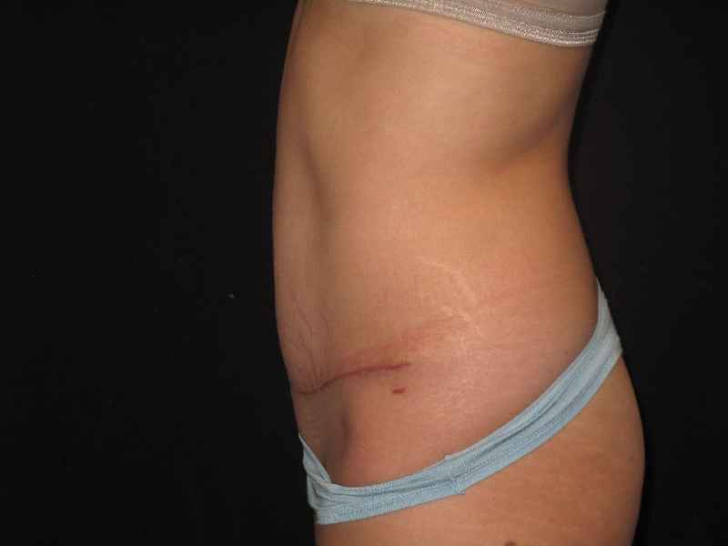 Is CoolSculpting same as tummy tuck
